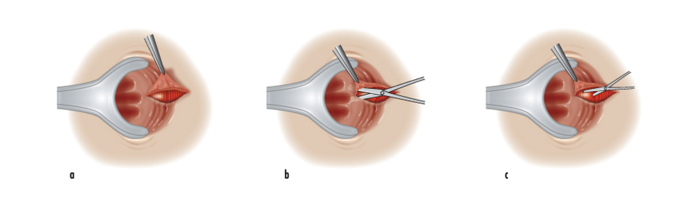 Anal Sphincterotomy  Dokilink-7286