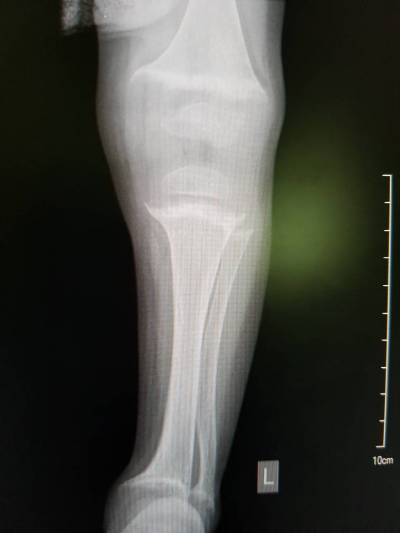 X-ray: AP of the leg