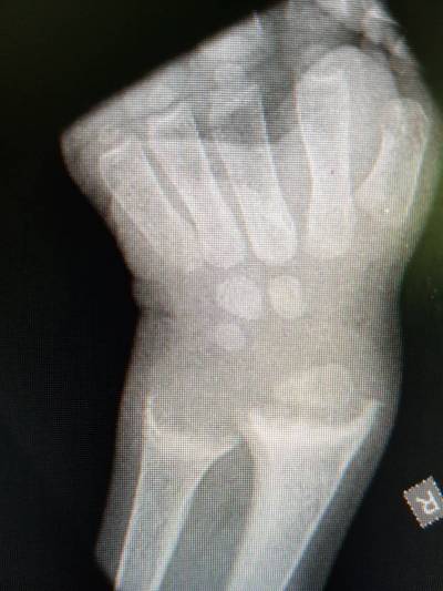 X-ray: AP of the wrist